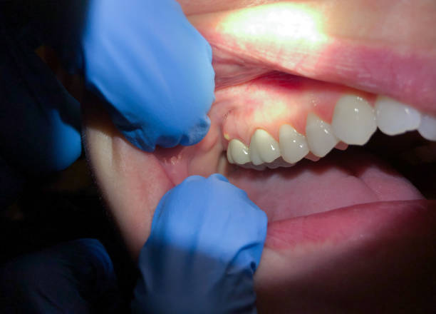 Best Emergency Dental Care for Abscessed Tooth in Walkertown, NC