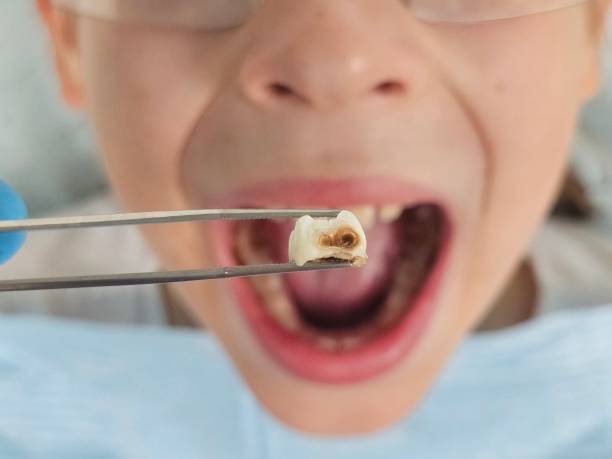 Best Emergency Dental Care for Abscessed Tooth in Walkertown, NC